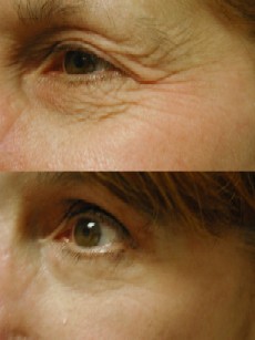 Madonna eyelift