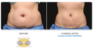 CoolSculpting-before-and-after-female-abdomen-treatment-to-transformation1