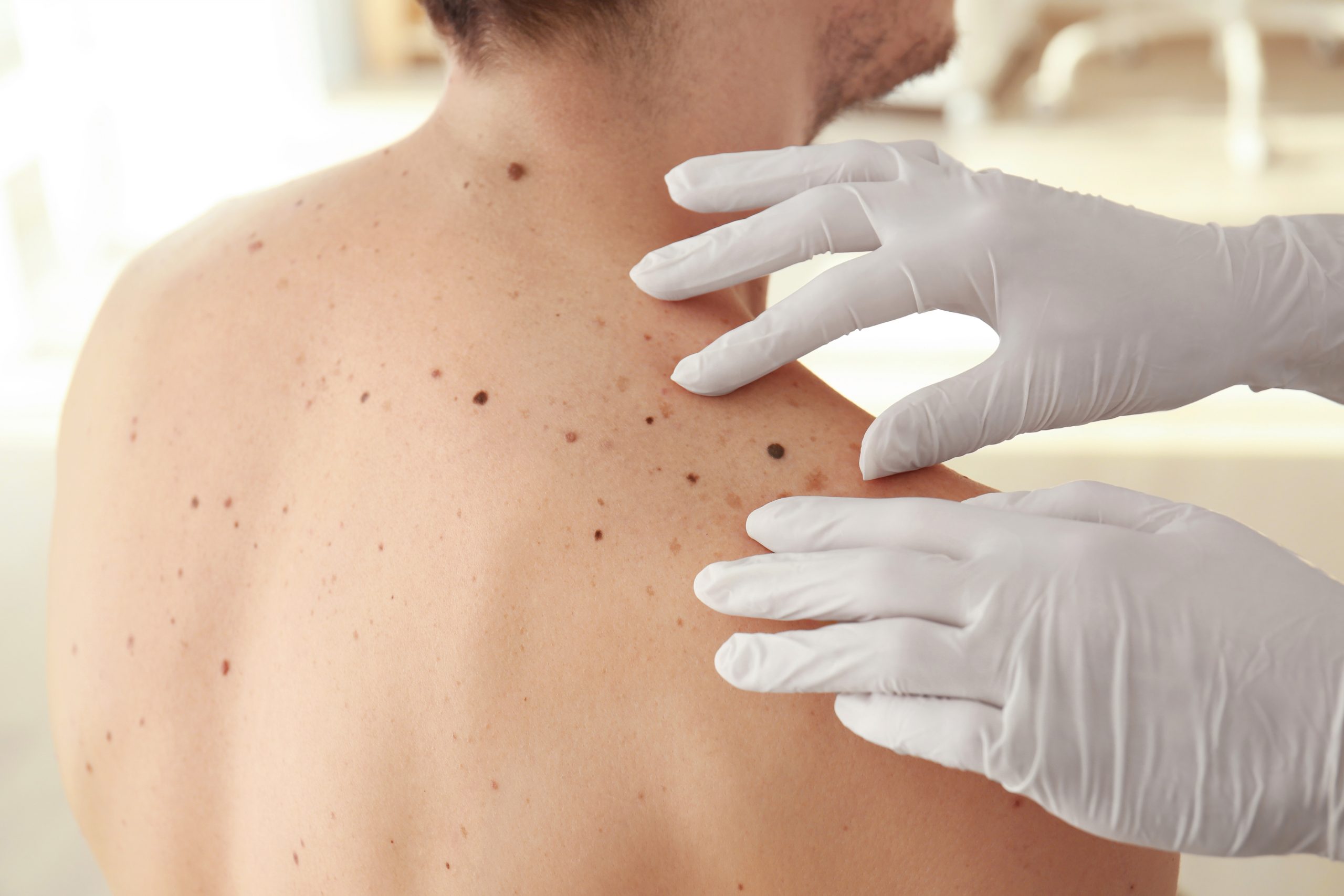 Mohs Surgery for Skin Cancer | CompDerm Center of Pasadena