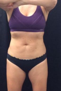 coolsculpting-