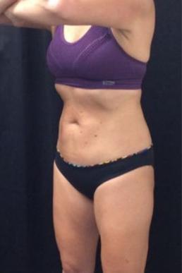 coolsculpting-