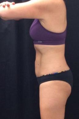 coolsculpting-