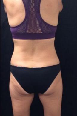 coolsculpting-