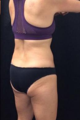 coolsculpting-