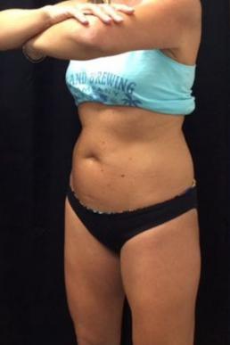 coolsculpting-