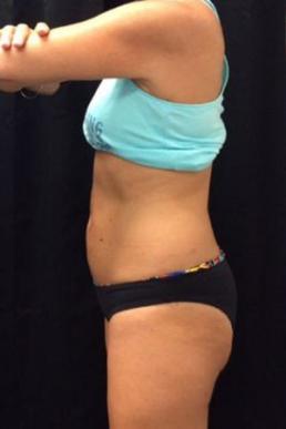 coolsculpting-