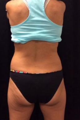 coolsculpting-