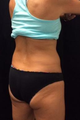 coolsculpting-