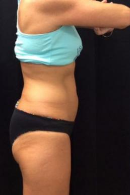 coolsculpting-