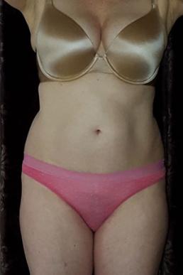 coolsculpting-