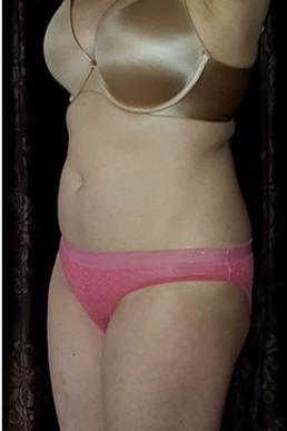 coolsculpting-