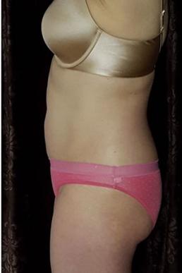 coolsculpting-