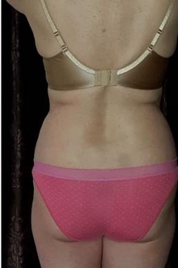 coolsculpting-