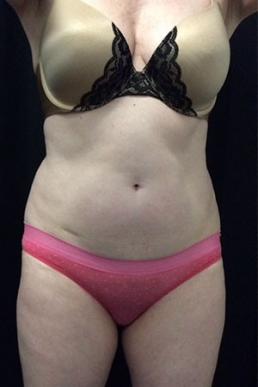 coolsculpting-