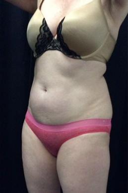 coolsculpting-