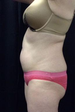 coolsculpting-
