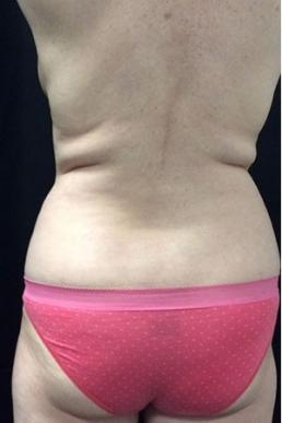 coolsculpting-