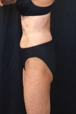 coolsculpting-