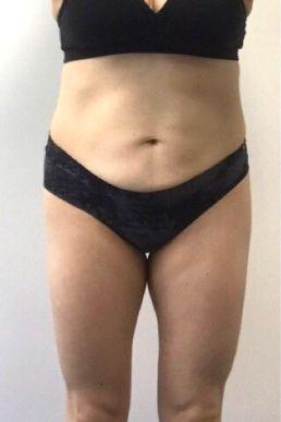coolsculpting-
