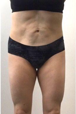 coolsculpting-