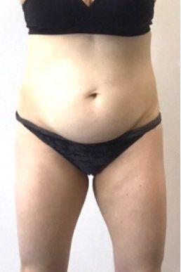 coolsculpting-