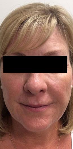 juvederm-