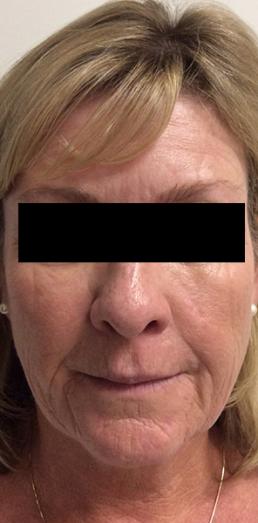 botox-