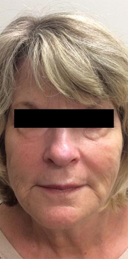 botox-