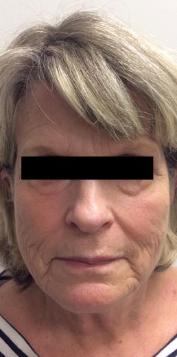 botox-