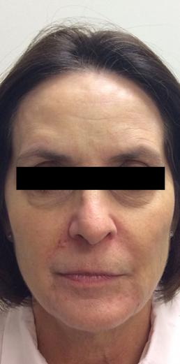 juvederm-