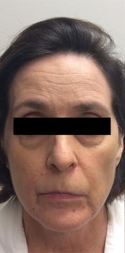 juvederm-