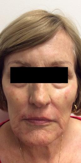 juvederm-