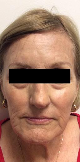 juvederm-