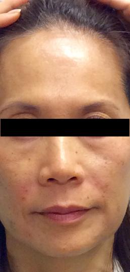 juvederm-