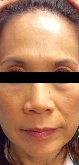 juvederm-