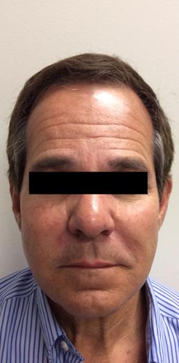 juvederm-