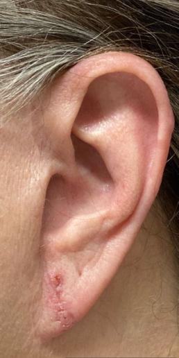 earlobe-repair-