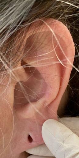 earlobe-repair-