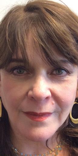juvederm-