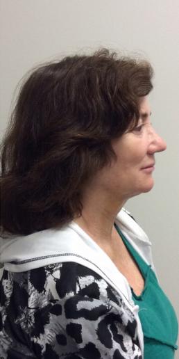 kybella-