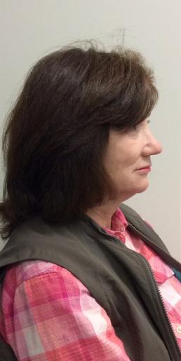 kybella-