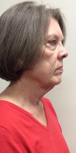 kybella-