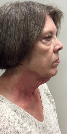 kybella-