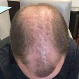 prp-hair-restoration-