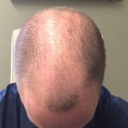 prp-hair-restoration-