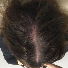 prp-hair-restoration-
