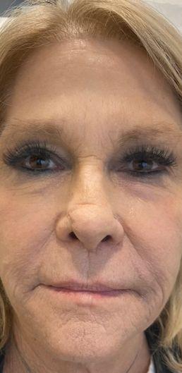 rha-filler-