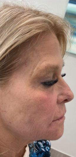rha-filler-