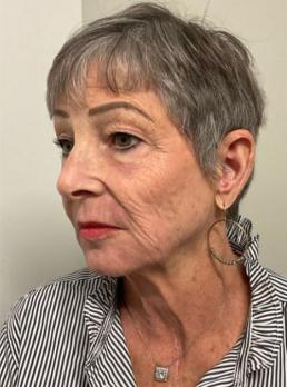 smartskin-co2-resurfacing-laser-