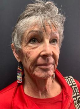 smartskin-co2-resurfacing-laser-